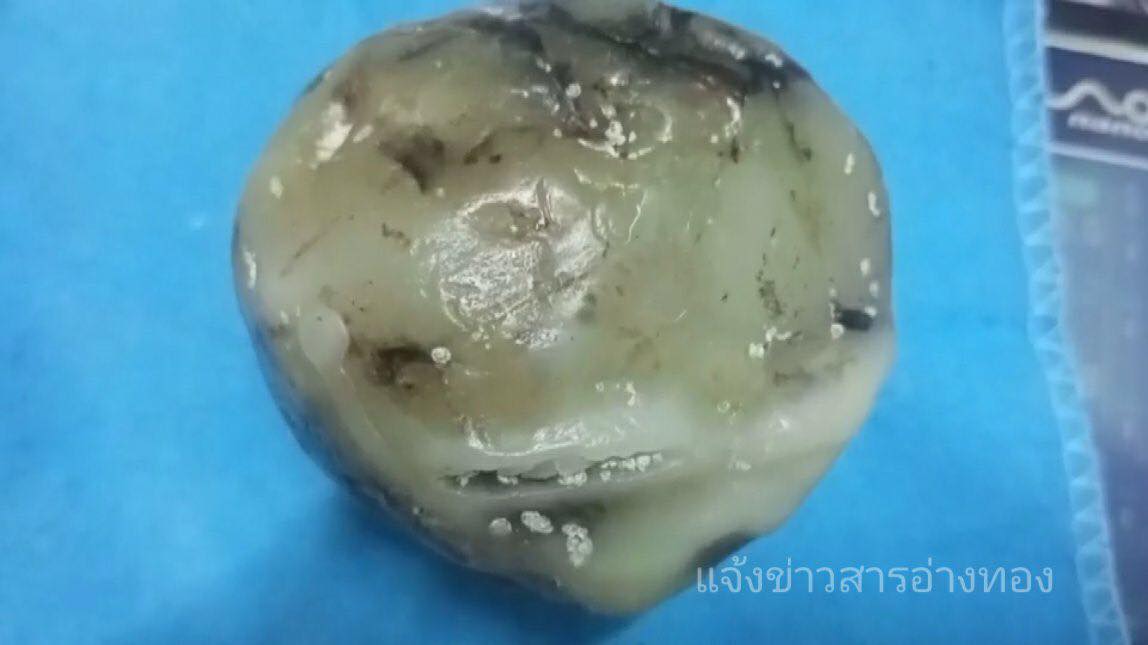 อ้วกวาฬ อ้วกวาฬ