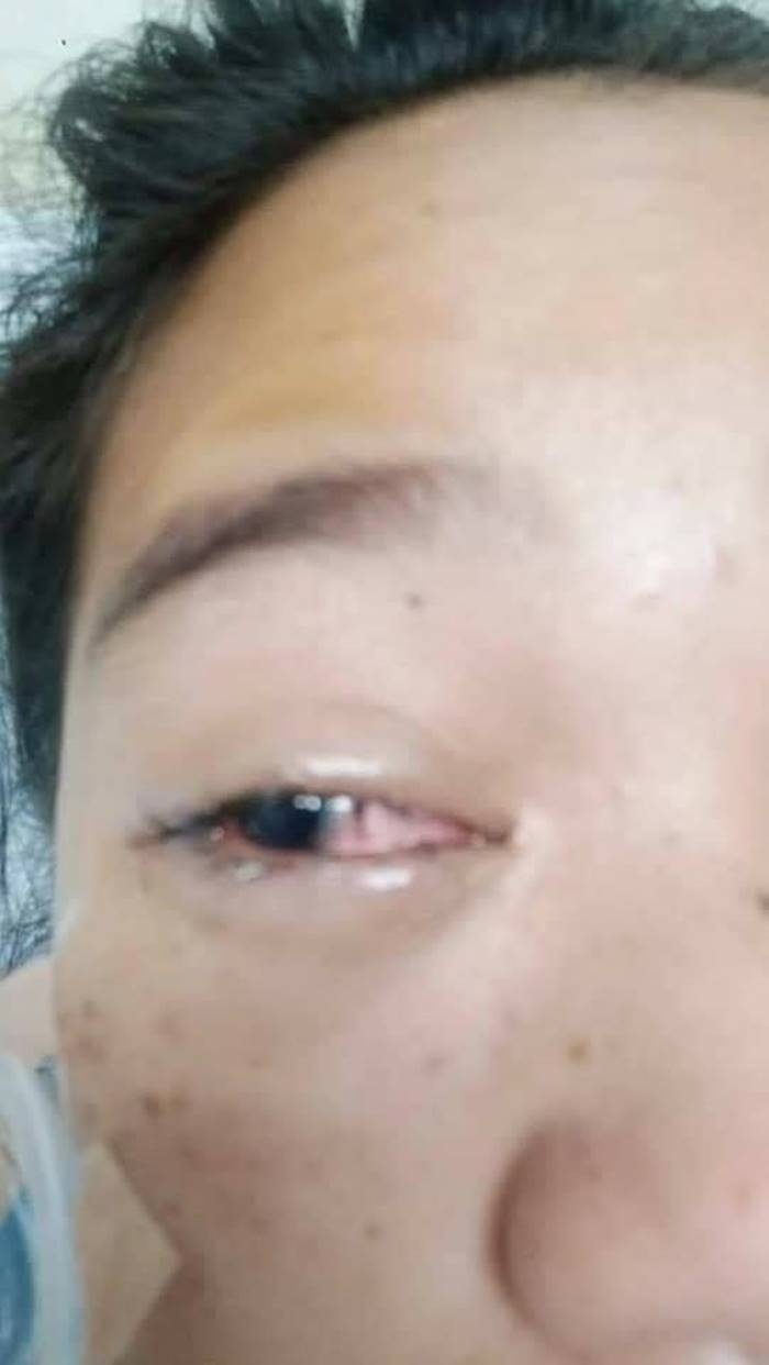 คอนแทคเลนส์ คอนแทคเลนส์