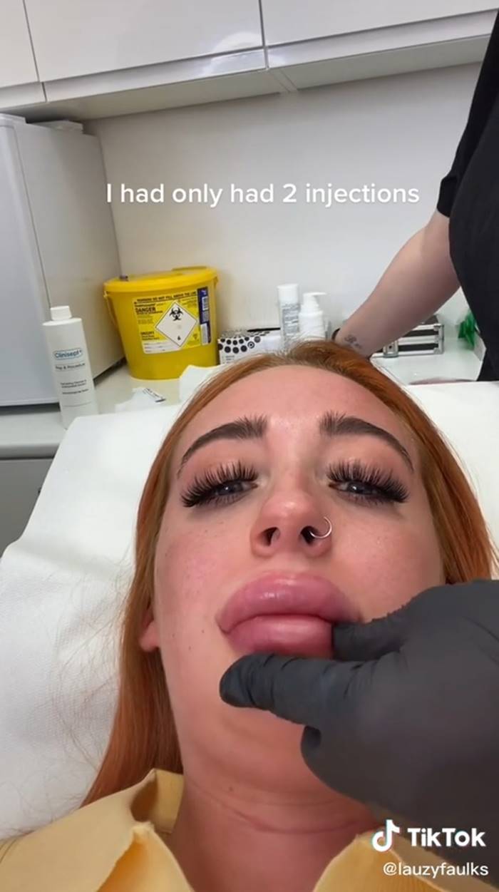 ฉีดฟิลเลอร์ ฉีดฟิลเลอร์