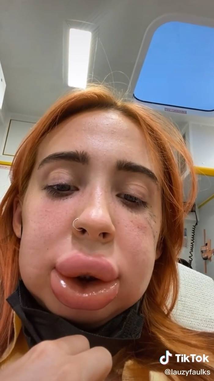 ฉีดฟิลเลอร์ ฉีดฟิลเลอร์