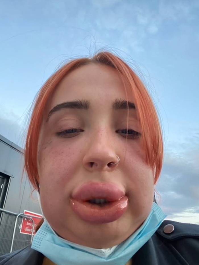 ฉีดฟิลเลอร์ ฉีดฟิลเลอร์