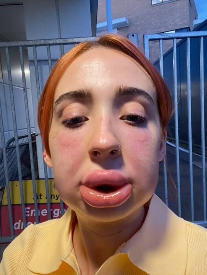 ฉีดฟิลเลอร์ ฉีดฟิลเลอร์