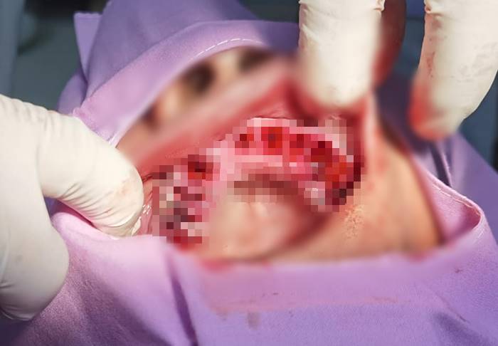 ฟันปลอมเถื่อน ฟันปลอมเถื่อน