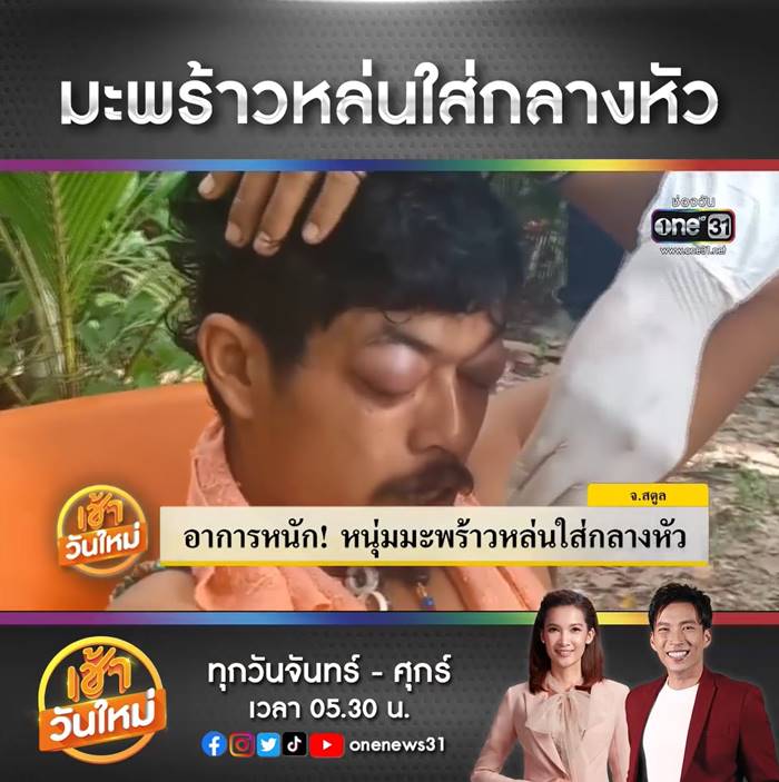 มะพร้าวตกใส่หัว มะพร้าวตกใส่หัว