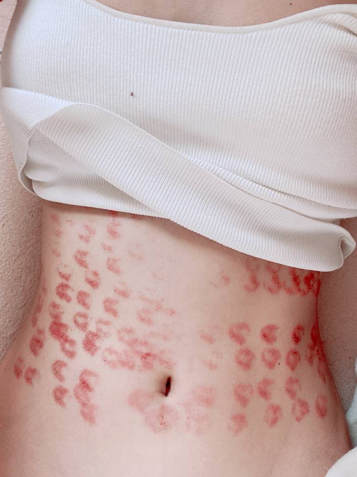 เลเซอร์กำจัดขน เลเซอร์กำจัดขน