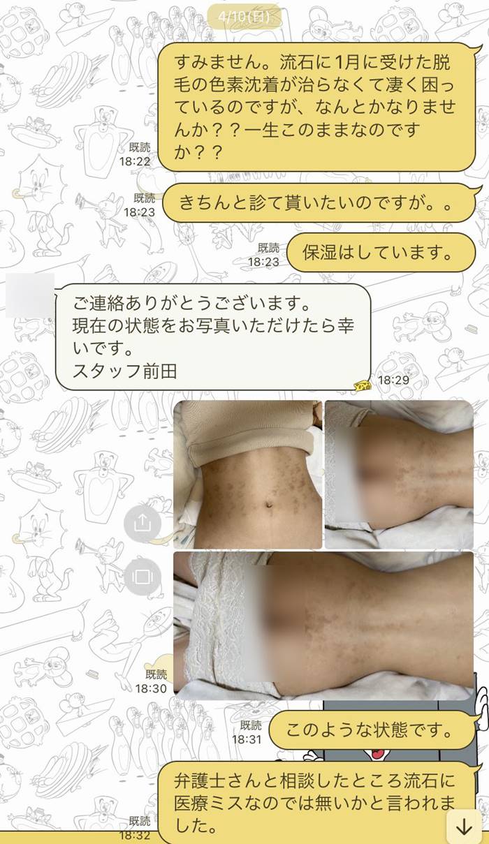 เลเซอร์กำจัดขน เลเซอร์กำจัดขน