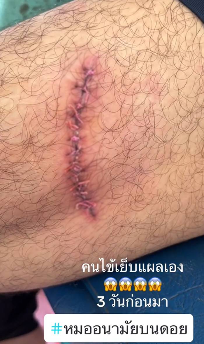 เย็บแผล เย็บแผล