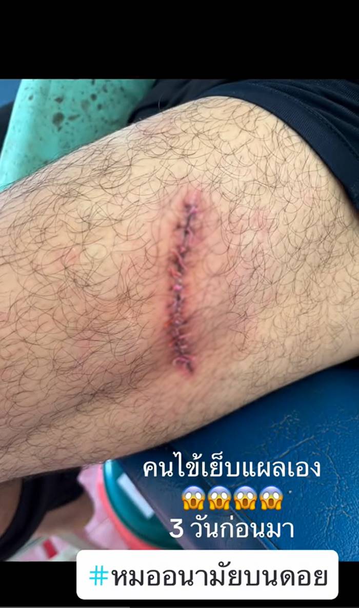 เย็บแผล เย็บแผล