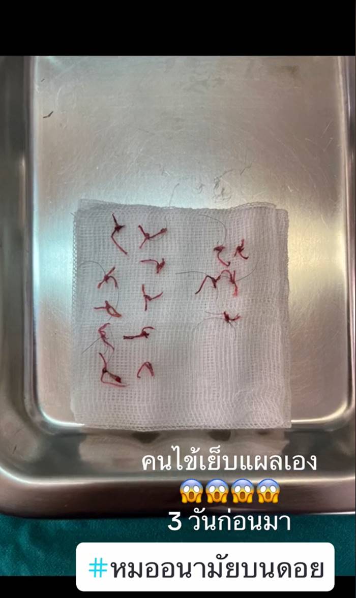 เย็บแผล เย็บแผล