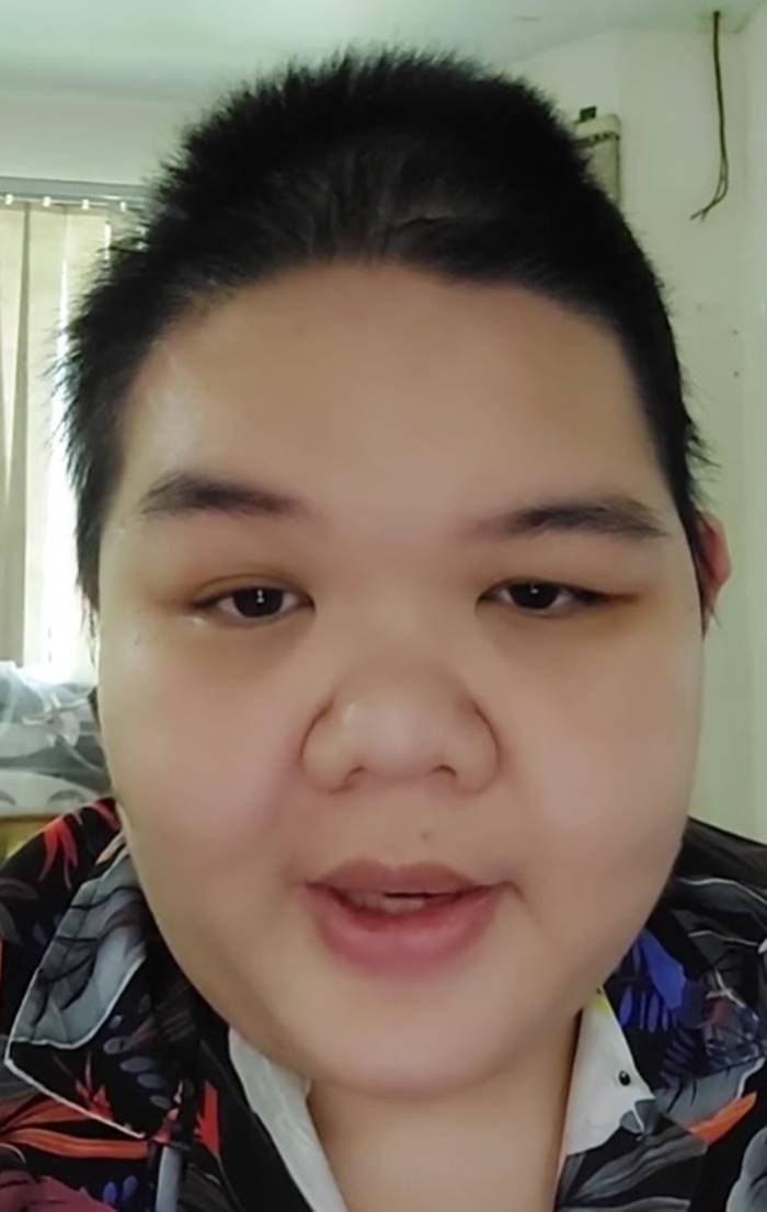 เส้นเลือดในสมองแตก เส้นเลือดในสมองแตก