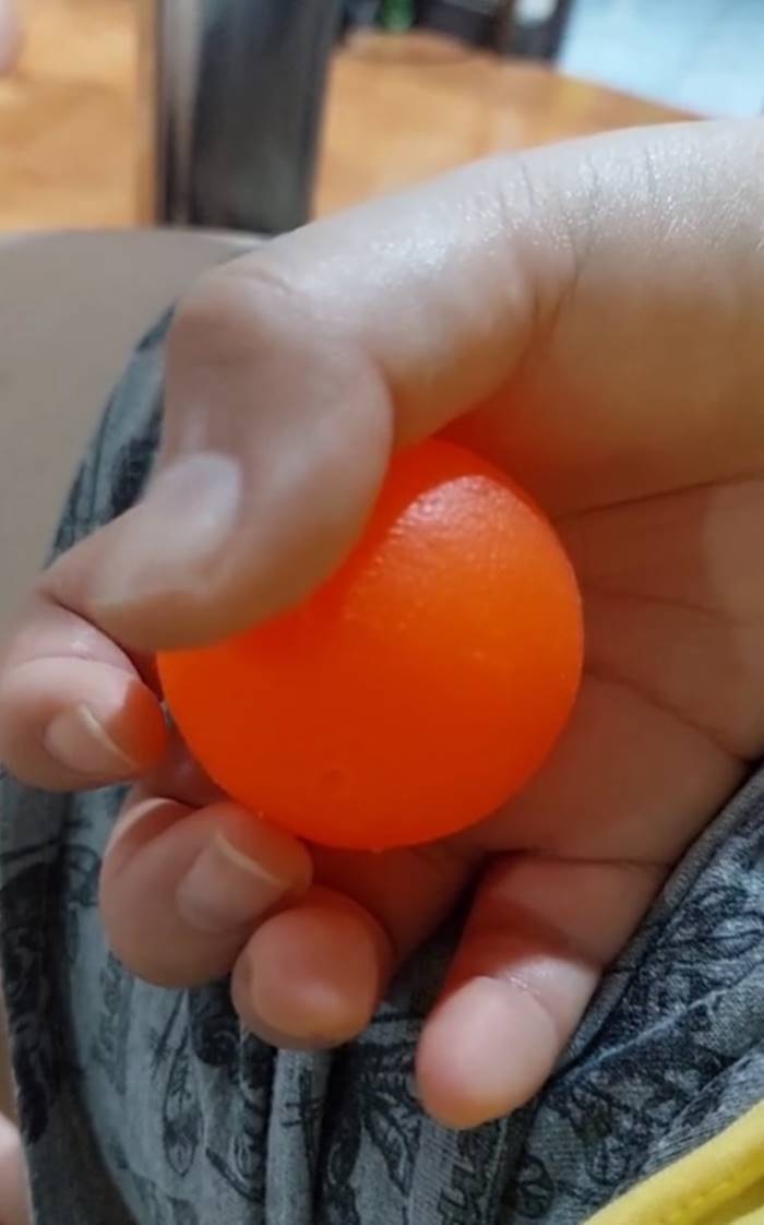 เส้นเลือดในสมองแตก เส้นเลือดในสมองแตก