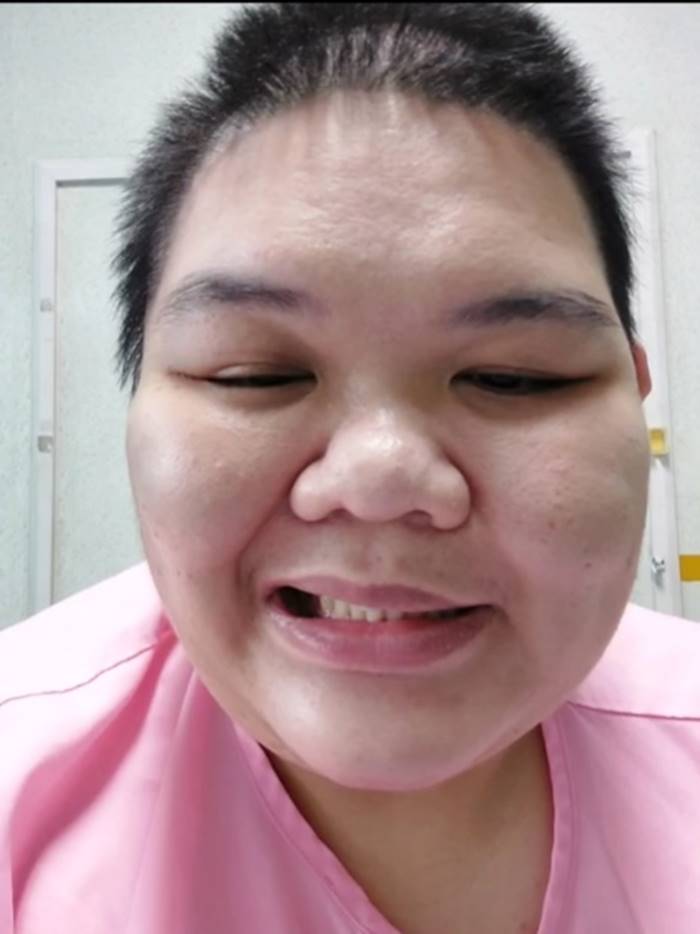 เส้นเลือดในสมองแตก เส้นเลือดในสมองแตก