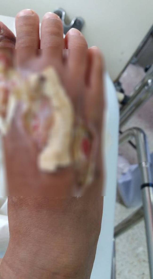 งูเห่ากัด งูเห่ากัด