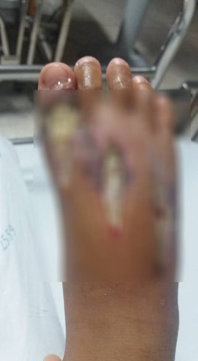 งูเห่ากัด งูเห่ากัด