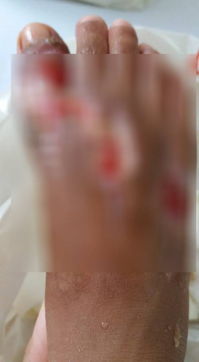 งูเห่ากัด งูเห่ากัด