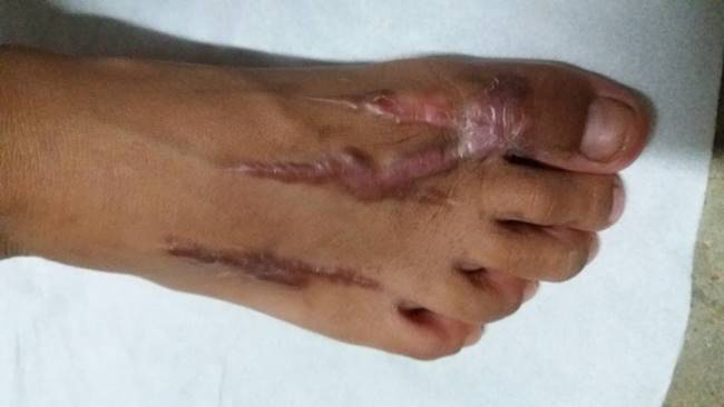 งูเห่ากัด งูเห่ากัด