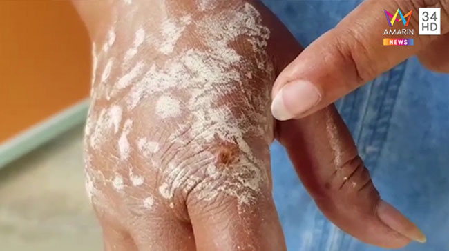 แมงมุมกัด แมงมุมกัด