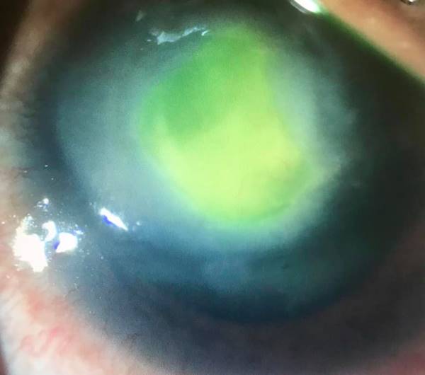 คอนแทคเลนส์ คอนแทคเลนส์