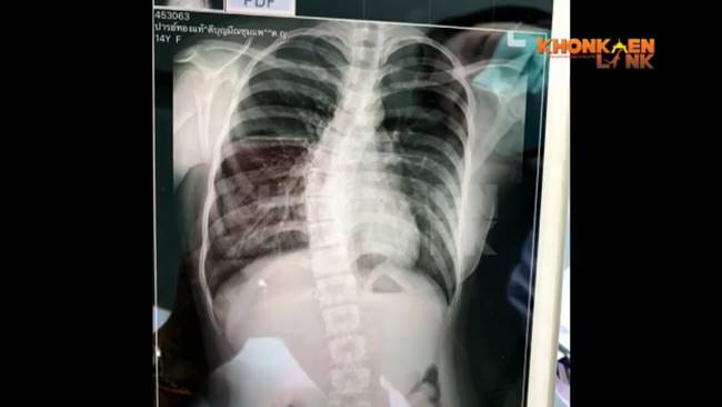 กระดูกสันหลังคดงอ กระดูกสันหลังคดงอ