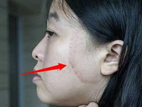 สาวจีนโวย iPhone 5S ทำหน้าไหม้ หลังโทรคุยกับแฟนนาน สาวจีนโวย iPhone 5S ทำหน้าไหม้ หลังโทรคุยกับแฟนนาน