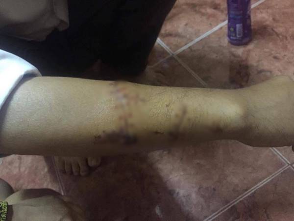 เพจดังเผย เหยื่อโจ๋รุมฆ่า น้องปอนด์ โดนมีดฟันแขนเย็บ 25 เข็ม-สภาพจิตใจแย่ เพจดังเผย เหยื่อโจ๋รุมฆ่า น้องปอนด์ โดนมีดฟันแขนเย็บ 25 เข็ม-สภาพจิตใจแย่