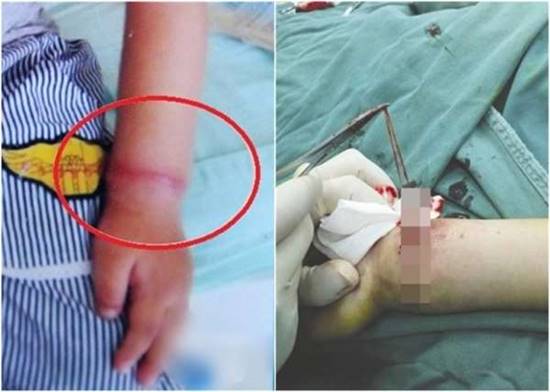 แพทย์ผงะ ! เคสสุดประหลาด ผ่าตัดพบ หนังยาง ในข้อมือเด็ก 4 ขวบ แพทย์ผงะ ! เคสสุดประหลาด ผ่าตัดพบ หนังยาง ในข้อมือเด็ก 4 ขวบ