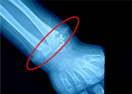 แพทย์ผงะ ! เคสสุดประหลาด ผ่าตัดพบ หนังยาง ในข้อมือเด็ก 4 ขวบ แพทย์ผงะ ! เคสสุดประหลาด ผ่าตัดพบ หนังยาง ในข้อมือเด็ก 4 ขวบแพทย์ผงะ ! เคสสุดประหลาด ผ่าตัดพบ หนังยาง ในข้อมือเด็ก 4 ขวบ