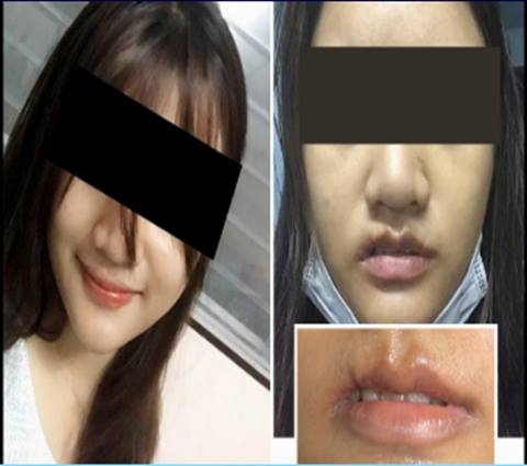 สาวเจ้าของร้านกาแฟโร่แจ้งความจับหมอศัลยกรรมพัทยา หลังผ่าตัดจนปากเบี้ยว สาวเจ้าของร้านกาแฟโร่แจ้งความจับหมอศัลยกรรมพัทยา หลังผ่าตัดจนปากเบี้ยว