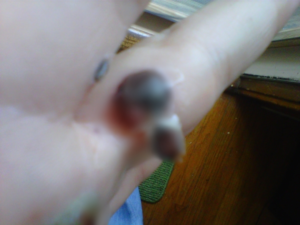 สยองหนักมาก หญิงป่วยตุ่มประหลาดสีดำขึ้นมือ ก่อนลุกลามจนแตก สยองหนักมาก หญิงป่วยตุ่มประหลาดสีดำขึ้นมือ ก่อนลุกลามจนแตก