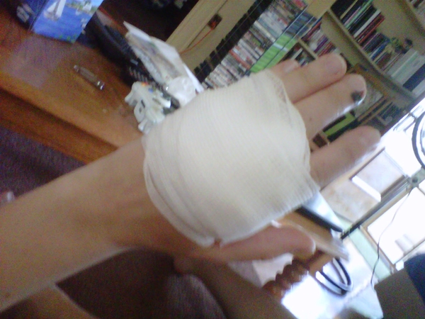 สยองหนักมาก หญิงป่วยตุ่มประหลาดสีดำขึ้นมือ ก่อนลุกลามจนแตก สยองหนักมาก หญิงป่วยตุ่มประหลาดสีดำขึ้นมือ ก่อนลุกลามจนแตก