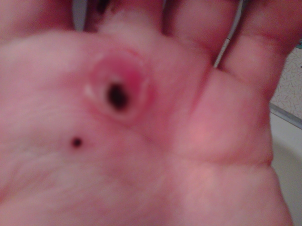 สยองหนักมาก หญิงป่วยตุ่มประหลาดสีดำขึ้นมือ ก่อนลุกลามจนแตก สยองหนักมาก หญิงป่วยตุ่มประหลาดสีดำขึ้นมือ ก่อนลุกลามจนแตก