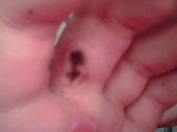 สยองหนักมาก หญิงป่วยตุ่มประหลาดสีดำขึ้นมือ ก่อนลุกลามจนแตก สยองหนักมาก หญิงป่วยตุ่มประหลาดสีดำขึ้นมือ ก่อนลุกลามจนแตก