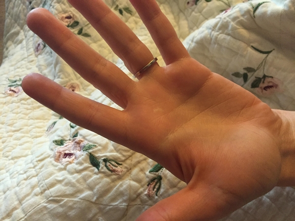 สยองหนักมาก หญิงป่วยตุ่มประหลาดสีดำขึ้นมือ ก่อนลุกลามจนแตก สยองหนักมาก หญิงป่วยตุ่มประหลาดสีดำขึ้นมือ ก่อนลุกลามจนแตก