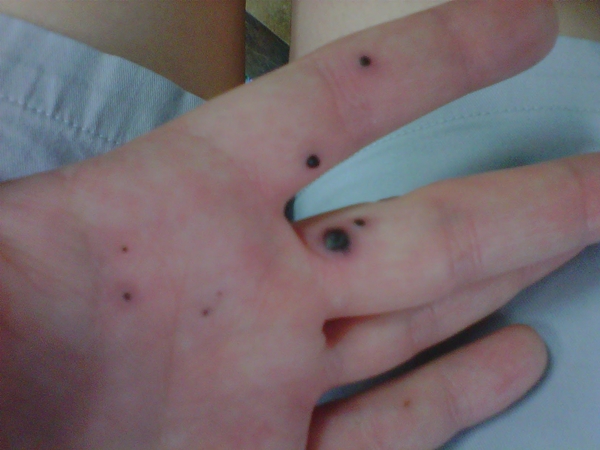 สยองหนักมาก หญิงป่วยตุ่มประหลาดสีดำขึ้นมือ ก่อนลุกลามจนแตก สยองหนักมาก หญิงป่วยตุ่มประหลาดสีดำขึ้นมือ ก่อนลุกลามจนแตก