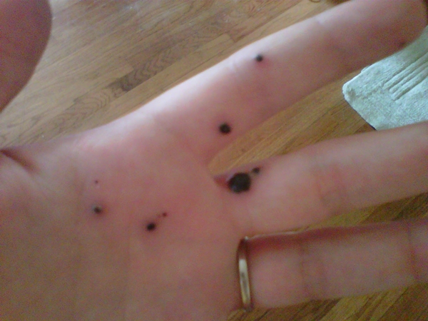 สยองหนักมาก หญิงป่วยตุ่มประหลาดสีดำขึ้นมือ ก่อนลุกลามจนแตก สยองหนักมาก หญิงป่วยตุ่มประหลาดสีดำขึ้นมือ ก่อนลุกลามจนแตก