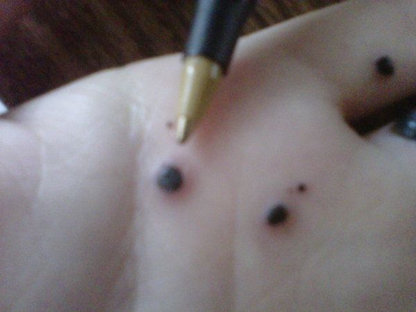 สยองหนักมาก หญิงป่วยตุ่มประหลาดสีดำขึ้นมือ ก่อนลุกลามจนแตก สยองหนักมาก หญิงป่วยตุ่มประหลาดสีดำขึ้นมือ ก่อนลุกลามจนแตก