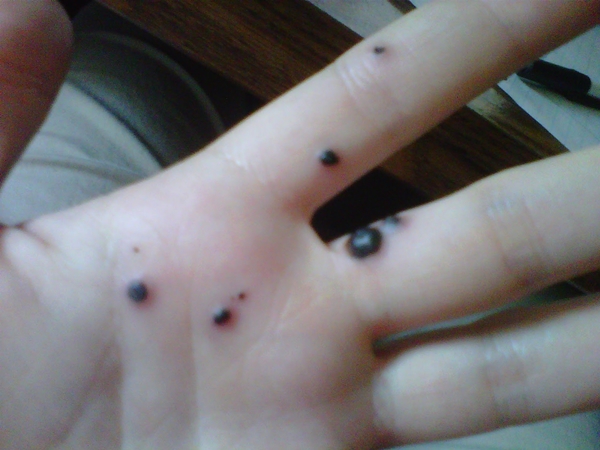 สยองหนักมาก หญิงป่วยตุ่มประหลาดสีดำขึ้นมือ ก่อนลุกลามจนแตก สยองหนักมาก หญิงป่วยตุ่มประหลาดสีดำขึ้นมือ ก่อนลุกลามจนแตก