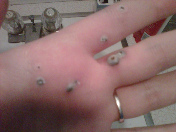 สยองหนักมาก หญิงป่วยตุ่มประหลาดสีดำขึ้นมือ ก่อนลุกลามจนแตก สยองหนักมาก หญิงป่วยตุ่มประหลาดสีดำขึ้นมือ ก่อนลุกลามจนแตก