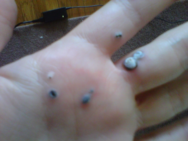 สยองหนักมาก หญิงป่วยตุ่มประหลาดสีดำขึ้นมือ ก่อนลุกลามจนแตก สยองหนักมาก หญิงป่วยตุ่มประหลาดสีดำขึ้นมือ ก่อนลุกลามจนแตก