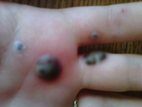 สยองหนักมาก หญิงป่วยตุ่มประหลาดสีดำขึ้นมือ ก่อนลุกลามจนแตก สยองหนักมาก หญิงป่วยตุ่มประหลาดสีดำขึ้นมือ ก่อนลุกลามจนแตก