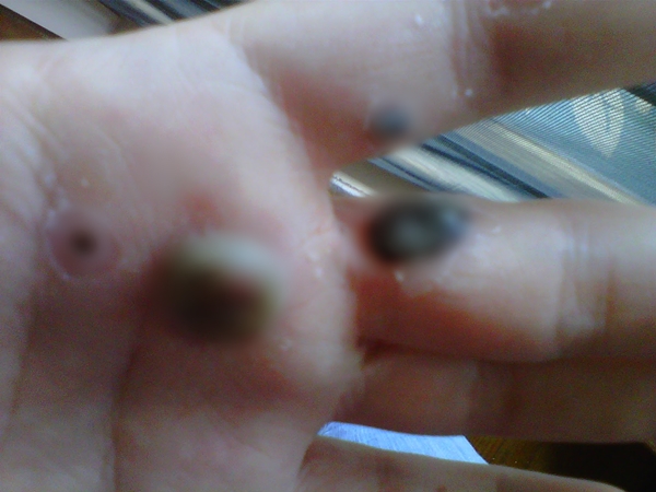 สยองหนักมาก หญิงป่วยตุ่มประหลาดสีดำขึ้นมือ ก่อนลุกลามจนแตก สยองหนักมาก หญิงป่วยตุ่มประหลาดสีดำขึ้นมือ ก่อนลุกลามจนแตก