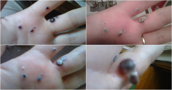 สยองหนักมาก หญิงป่วยตุ่มประหลาดสีดำขึ้นมือ ก่อนลุกลามจนแตก สยองหนักมาก หญิงป่วยตุ่มประหลาดสีดำขึ้นมือ ก่อนลุกลามจนแตก