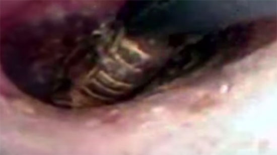 สยอง ! คลิปหมอคีบตะขาบออกจากหูสาว หลังตื่นมาปวดหูหนัก สยอง ! คลิปหมอคีบตะขาบออกจากหูสาว หลังตื่นมาปวดหูหนัก