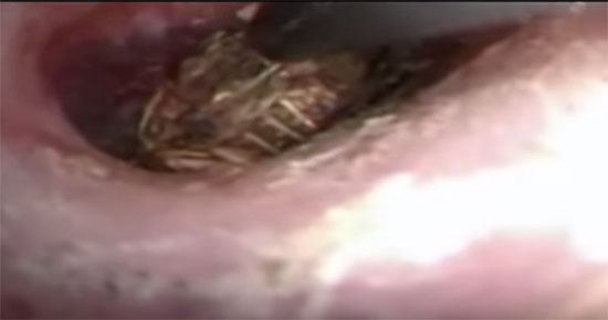 สยอง ! คลิปหมอคีบตะขาบออกจากหูสาว หลังตื่นมาปวดหูหนัก สยอง ! คลิปหมอคีบตะขาบออกจากหูสาว หลังตื่นมาปวดหูหนัก