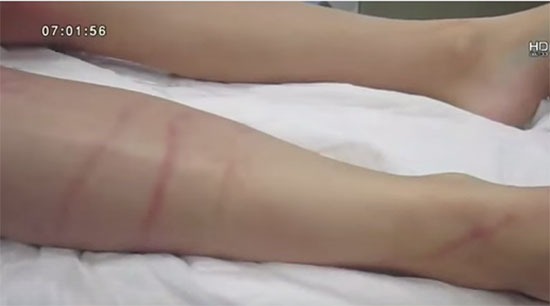 สังเวยอีกราย สาวเยอรมันเล่นน้ำทะเลเกาะสมุย โดนพิษแมงกะพรุนกล่องดับ สังเวยอีกราย สาวเยอรมันเล่นน้ำทะเลเกาะสมุย โดนพิษแมงกะพรุนกล่องดับ