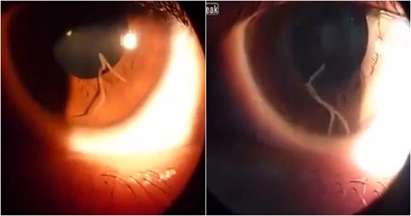 เมื่อพยาธิตัวยาวดิ้นดุกดิก เคลื่อนไหวไปมาอยู่ในลูกตาของผู้ป่วยหญิงรายหนึ่ง เมื่อพยาธิตัวยาวดิ้นดุกดิก เคลื่อนไหวไปมาอยู่ในลูกตาของผู้ป่วยหญิงรายหนึ่ง
