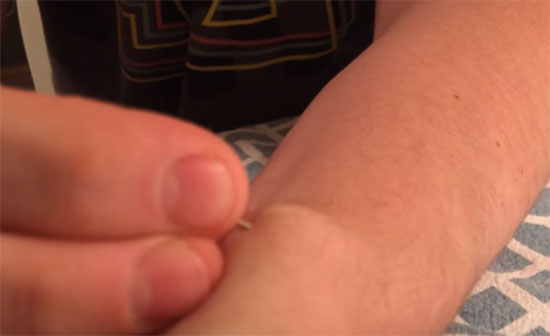 หวาดเสียว คลิปหนุ่มใช้หมุดเจาะซีสต์ที่ข้อมือ บีบเค้นจนทะลักกองเบ้อเร่อ หวาดเสียว คลิปหนุ่มใช้หมุดเจาะซีสต์ที่ข้อมือ บีบเค้นจนทะลักกองเบ้อเร่อ