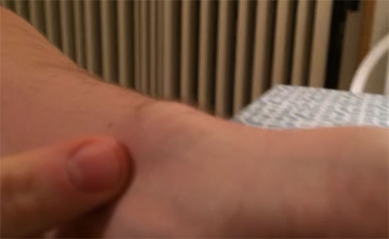 หวาดเสียว คลิปหนุ่มใช้หมุดเจาะซีสต์ที่ข้อมือ บีบเค้นจนทะลักกองเบ้อเร่อ หวาดเสียว คลิปหนุ่มใช้หมุดเจาะซีสต์ที่ข้อมือ บีบเค้นจนทะลักกองเบ้อเร่อ