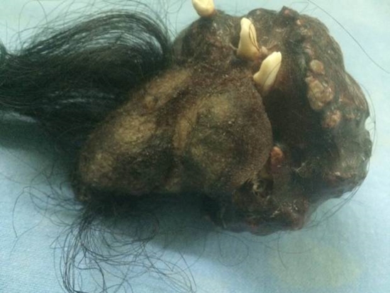 หนุ่มอาเจียนหนัก ไปหาหมอสุดช็อก พบฝาแฝดเติบโตอยู่ภายในท้องตัวเอง หนุ่มอาเจียนหนัก ไปหาหมอสุดช็อก พบฝาแฝดเติบโตอยู่ภายในท้องตัวเอง