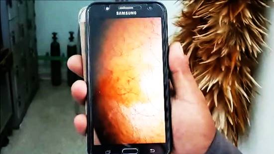 น่ากลัว ! ชายชาวระยองถูกแมงมุมมีพิษกัด ไม่ไปหาหมอ สุดท้ายเสียชีวิต น่ากลัว ! ชายชาวระยองถูกแมงมุมมีพิษกัด ไม่ไปหาหมอ สุดท้ายเสียชีวิต